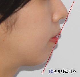 치료 후 ①
