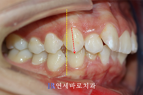 치료 전 ②