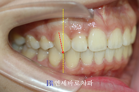 치료 후 ②