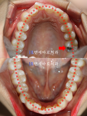 치료 전 ③