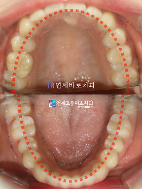 치료 후 ③