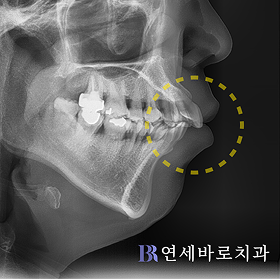 치료 전 ①