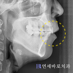 치료 후 ①