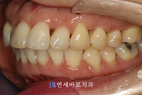 치료 전 ②