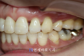 치료 후 ②