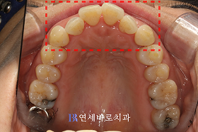 치료 전 ③