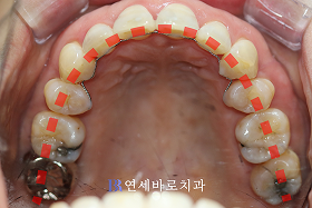 치료 후 ③