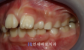 치료 전 ①