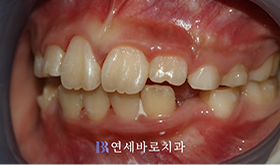 치료 후 ①