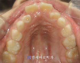 치료 전 ②