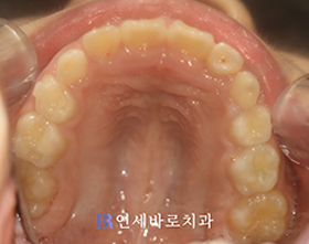 치료 후 ②