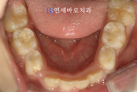 치료 전 ③