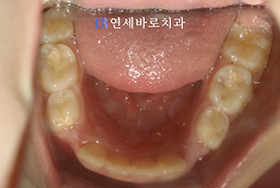 치료 후 ③