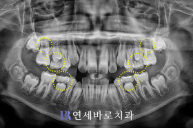 치료 전 ②
