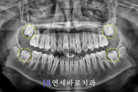 치료 후 ②
