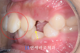 치료 전 ③