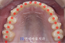 치료 후 ④