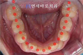 치료 전 ⑤