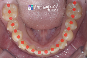 치료 후 ⑤