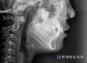 치료 전 ①