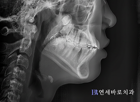 치료 후 ①