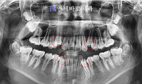 치료 전 ②