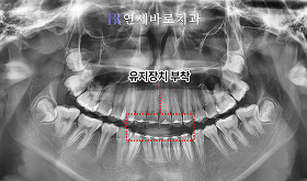 치료 후 ②