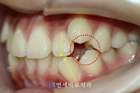 치료 전 ③