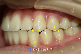 치료 후 ③