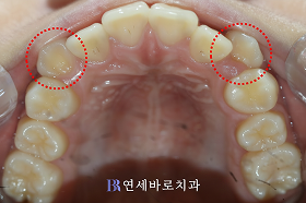 치료 전 ④