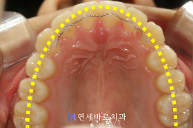 치료 후 ④