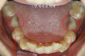 치료 전 ⑤
