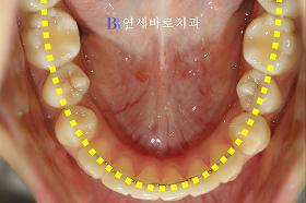 치료 후 ⑤
