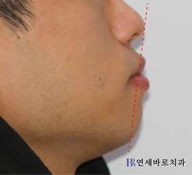 치료 전 ①