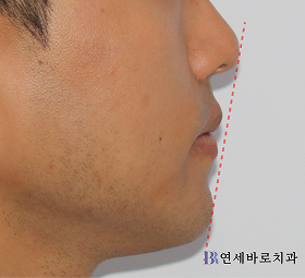 치료 후 ①