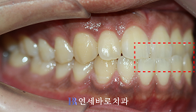 치료 전 ②