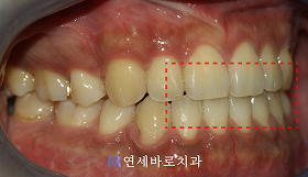 치료 후 ②