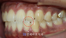 치료 전 ③
