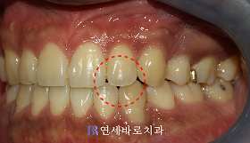 치료 후 ③