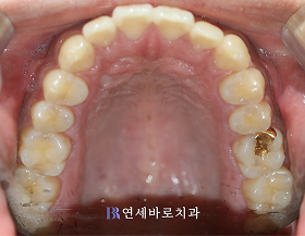 치료 전 ④