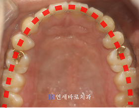 치료 후 ④