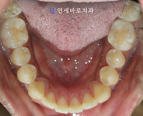 치료 전 ⑤