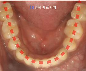치료 후 ⑤