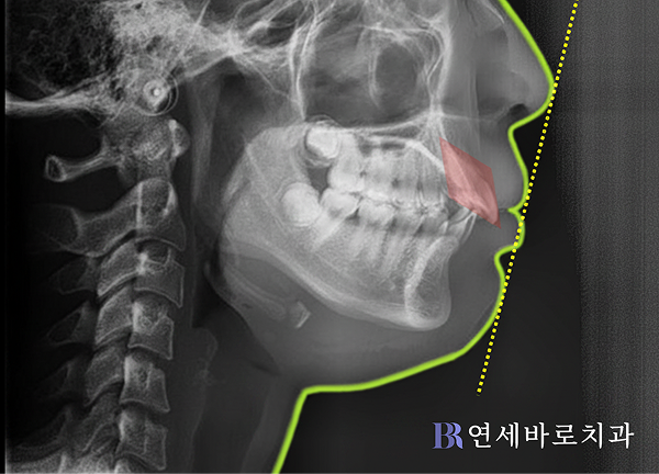 초진 아래턱 사진