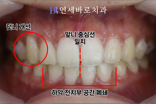 치료 후 정면 구내 사진