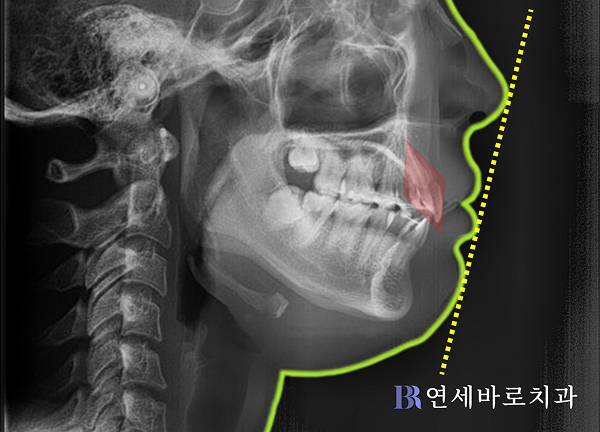 치료 전후 측면 안모