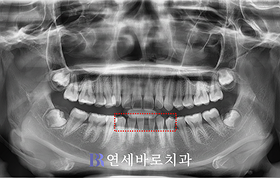 치료 전 ①