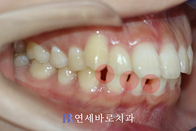 치료 전 ②
