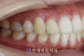 치료 후 ②