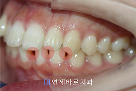 치료 전 ③